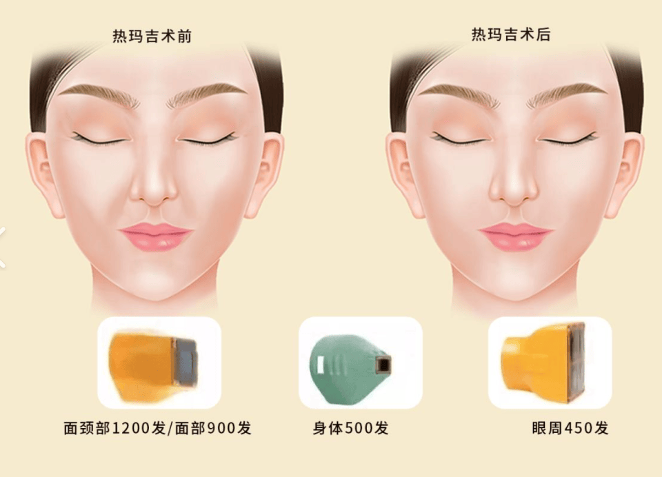 差别：超玛吉和热玛吉的区别，超声炮和热玛吉效果的区别